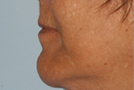 Chin Implant After - Dr. Paul Blair, Hurricane, WV