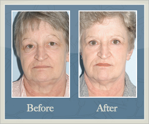 Lower Eyelid Surgery Before and After, Hurricane, WV