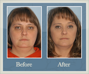 Facial Liposuction Before and After Hurricane, WV