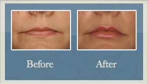 Facial Fillers Before and After Hurricane, WV