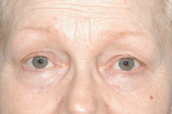 Eyelid Lift Before - Dr. Paul Blair, Hurricane, WV