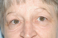 Eyelid Lift Before - Dr. Paul Blair, Hurricane, WV