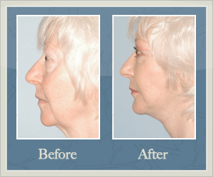 Chin Implants Before and After Hurricane, WV
