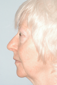 Chin Implant Before - Dr. Paul Blair, Hurricane, WV