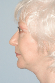 Chin Implant After - Dr. Paul Blair, Hurricane, WV