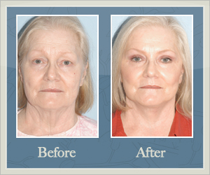 Upper Eyelid Lift Before and After, Hurricane, WV