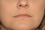 Facial Liposuction After - Dr. Paul Blair, Hurricane, WV