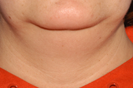 Neck Liposuction Before - Dr. Paul Blair, Hurricane, WV