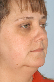 Facial Liposuction Before - Dr. Paul Blair, Hurricane, WV
