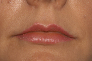 Injectable Fillers After - Dr. Paul Blair, Hurricane, WV