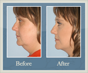 Full Neck Liposuction Before and After Hurricane, WV