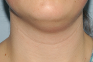 Neck Liposuction Before - Dr. Paul Blair, Hurricane, WV