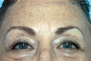 Forehead Lift After - Dr. Paul Blair, Hurricane, WV